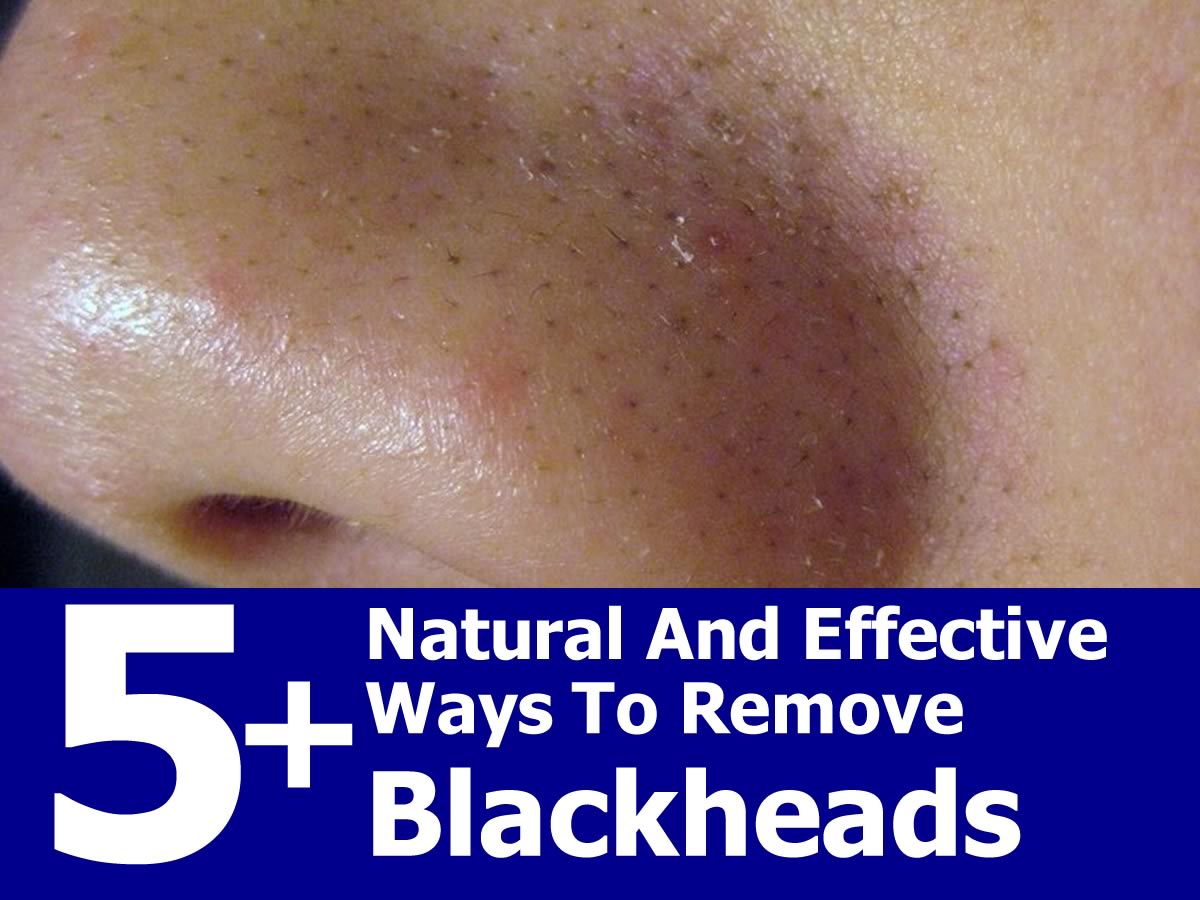 Natural Remedies To Remove Blackheads From Nose Natural Remedies To Remove Blackheads From Nose