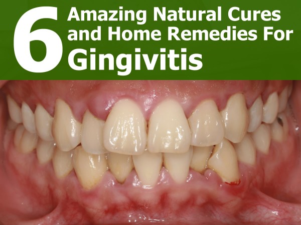 6-natural-cures-and-home-remedies-for-gingivitis