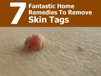 remove-skin-tags